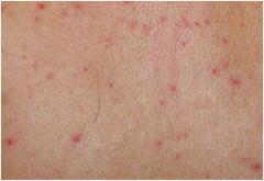 Skin Infections