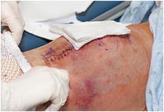 Wound Healing